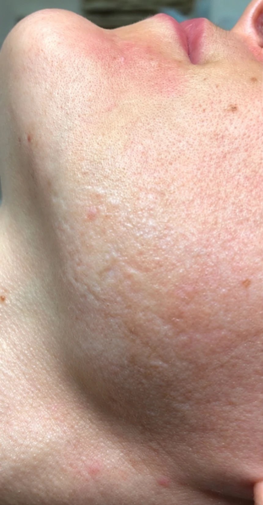 Close-up van een kin met roodheid en oneffen huidtextuur vóór de behandeling